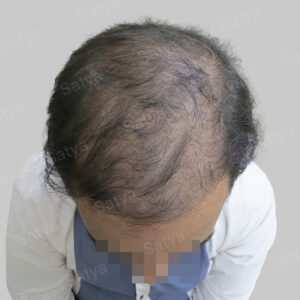 repair hair transplant