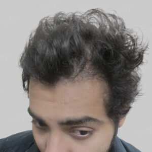 wrong hair transplant