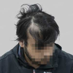 repair hair transplant