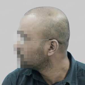 wrong hair transplant