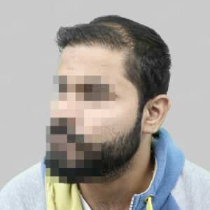 repair hair transplant result