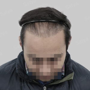 corrective hair transplant