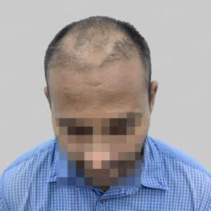 repair hair transplant