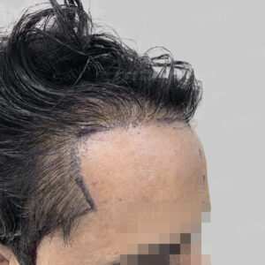 repair hair transplant result