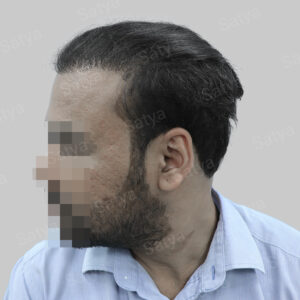wrong hair transplant