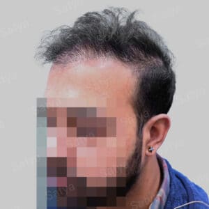 corrective hair transplant
