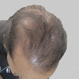 repair hair transplant