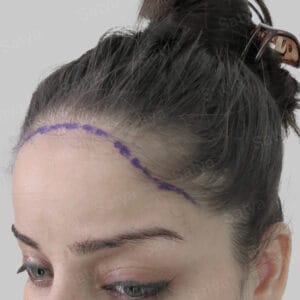 female hair transplant