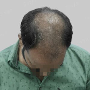 synthetic hair implant