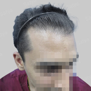repair hair transplant