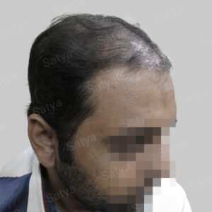 repair hair transplant
