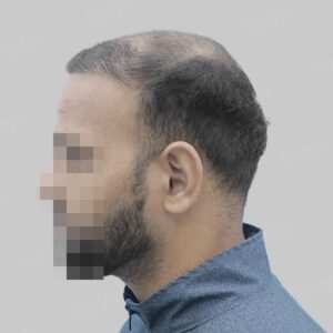 repair hair transplant