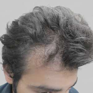 wrong hair transplant
