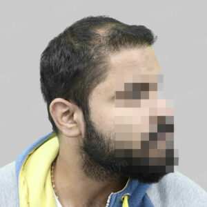 wrong hair transplant