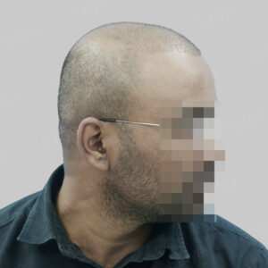 wrong hair transplant