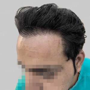 repair hair transplant result