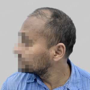 repair hair transplant