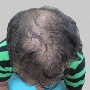 wrong hair transplant