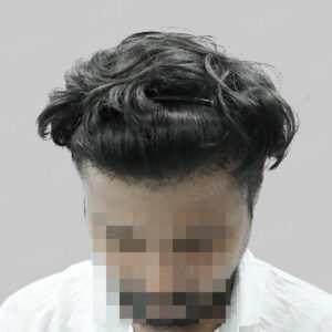 repair hair transplant