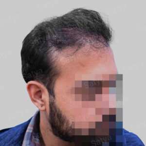 corrective hair transplant