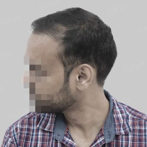 repair hair transplant