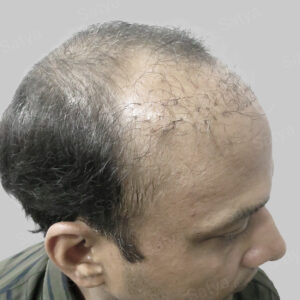 repair hair transplant