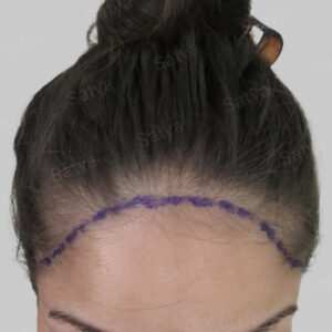 female hair transplant