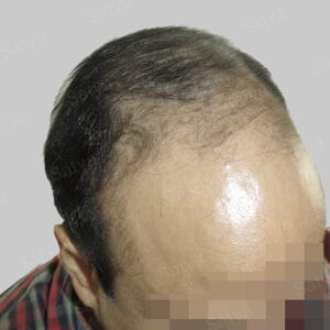 hair transplant