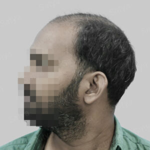 synthetic hair implant