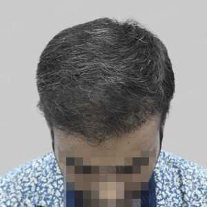 wrong hair transplant