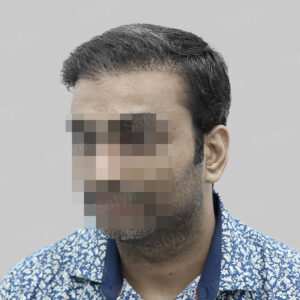 wrong hair transplant