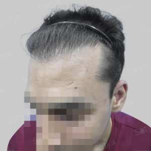 repair hair transplant