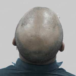 wrong hair transplant