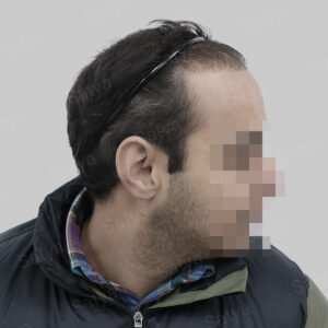 corrective hair transplant