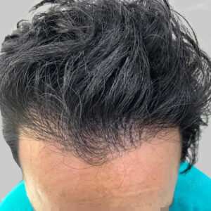 repair hair transplant result