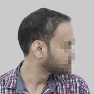 repair hair transplant