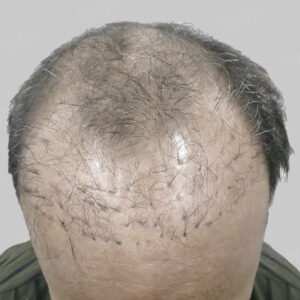 repair hair transplant