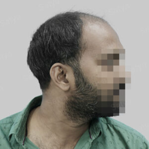 synthetic hair implant