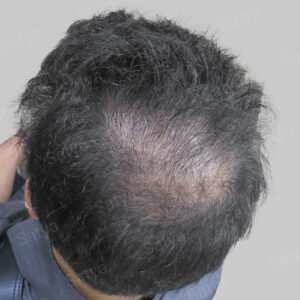 wrong hair line repair