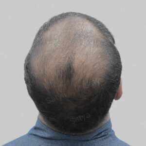 repair hair transplant