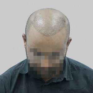 wrong hair transplant