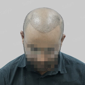 wrong hair transplant