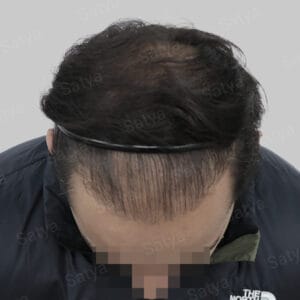 corrective hair transplant