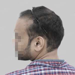 repair hair transplant