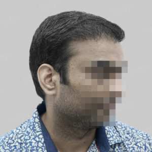 wrong hair transplant