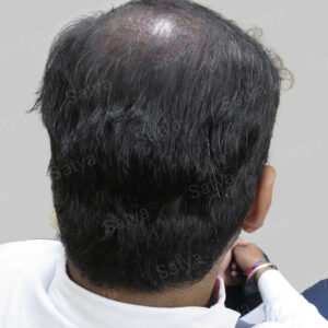 repair hair transplant