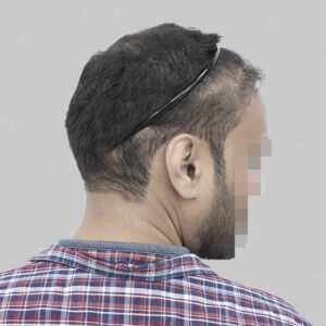 repair hair transplant