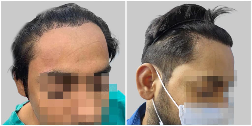 repair hair transplant