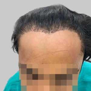 repair hair transplant