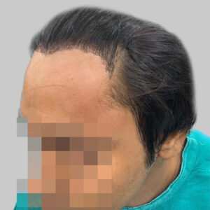 repair hair transplant